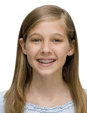 Life with Braces - Vivian Lee Orthodontics | Arcadia CA