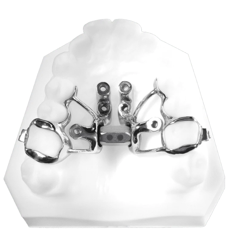 Tiger Screw MARPE 2 — maxillary skeletal expander showing titanium mini-screw anchors, used at Vivian Lee Orthodontics Arcadia