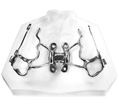 Tiger Screw MARPE 3 — MSE palatal expander alternate angle showing screw mechanism for skeletal arch widening